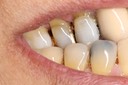 63Mendel Sato #4 crossbite