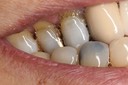 64Mendel Sato #4 cross bite