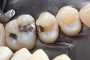 Alan Chinn #13 amalgam removal