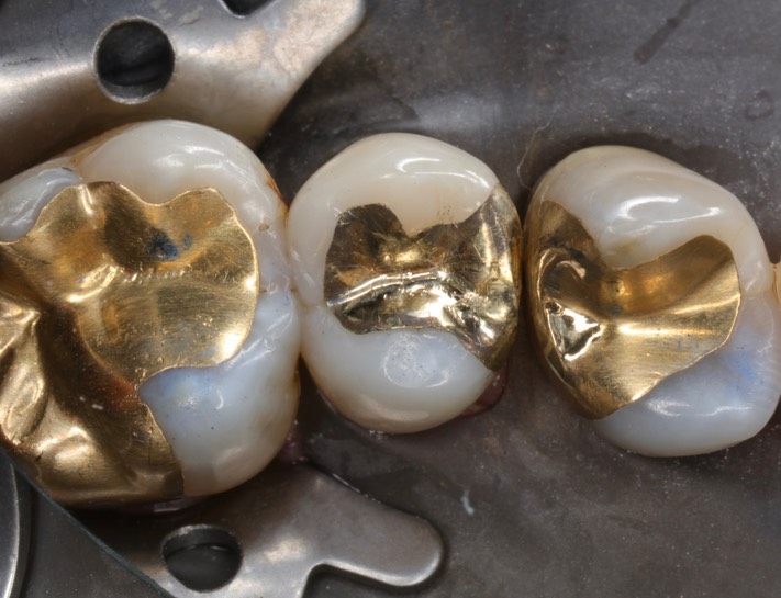 Alan Chinn #13 pre-cementation