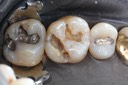 Alan Chinn #14 caries removal
