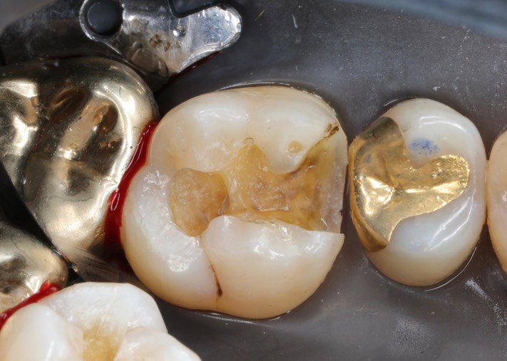 Alan Chinn #14 caries removal