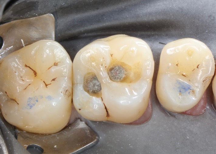 Alan Chinn #14 caries removal