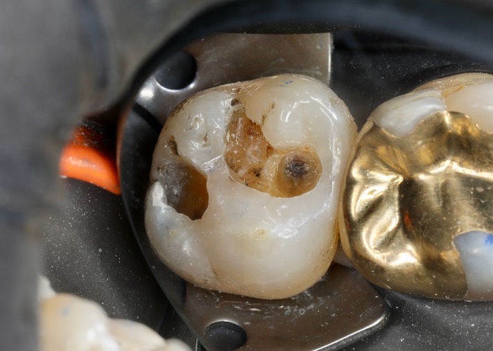 Alan Chinn #15 caries removal