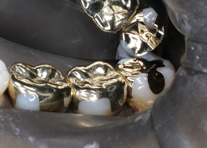 Alan Chinn #17 finish buccal view