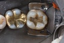 Alan Chinn #18 amalgam removal