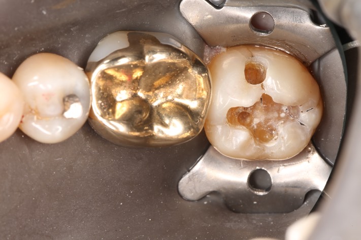 Alan Chinn #18 caries removal
