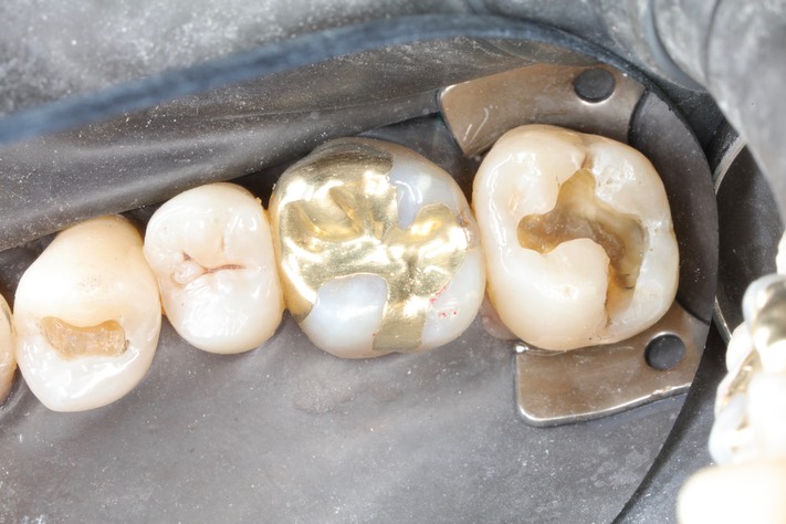 Alan Chinn #2 & 5 amalgam removal
