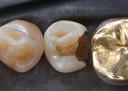 Alan Chinn #20 caries removal