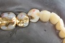 Alan Chinn #28 caries removal