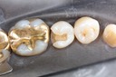 Alan Chinn #29 composite removal