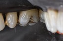 Alan Chinn #3 buccal view