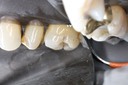 Alan Chinn #3 buccal