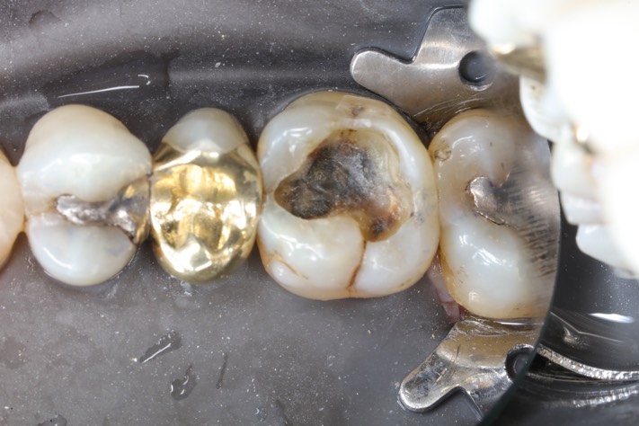 Alan Chinn #3 caries removal