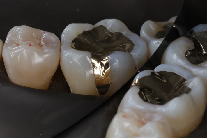 Alan Chinn #30 buccal view