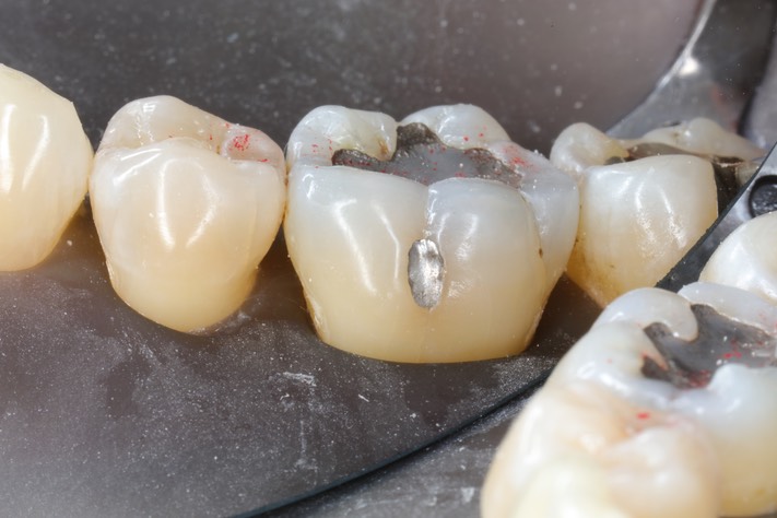 Alan Chinn #30 pre-op buccal view