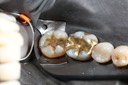 Alan Chinn #31 caries removal
