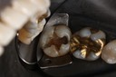 Alan Chinn #31 caries removal
