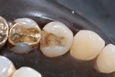 Brandon Yokota #28 amalgam removal