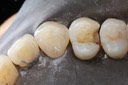 Brian Sato #12 amalgam removal