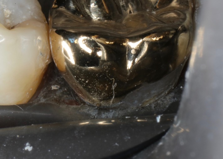 Brian Sato #14 finish buccal