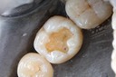 Brian Sato #19 amalgam removal