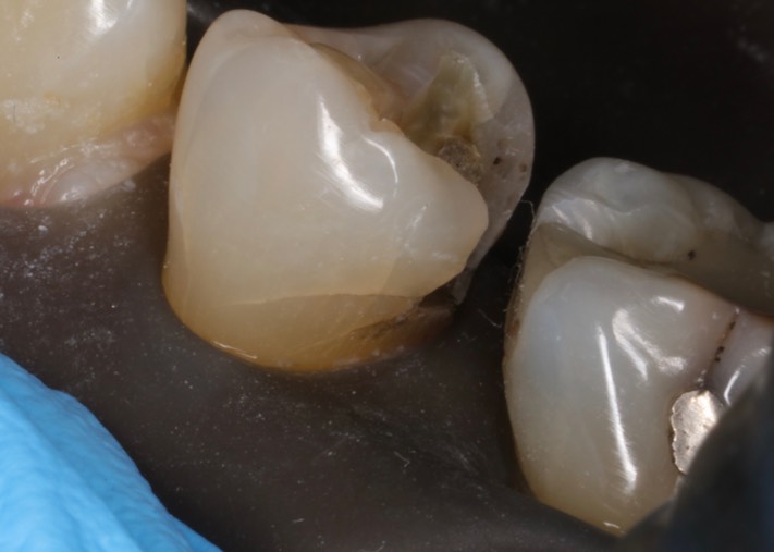 Brian Sato #20 buccal view