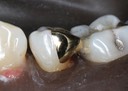 Brian Sato #20 finish - buccal view