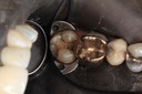 Brian Sato #15 amalgam removal