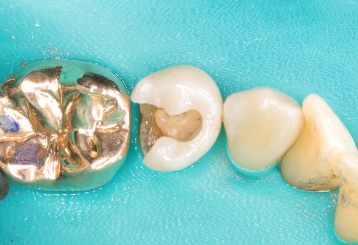 Bryan Sato #29 amalgam removal