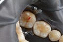 Bryan Sato #31 amalgam removal