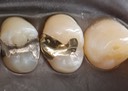 Chris Woo @12 pre-cementation