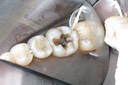 Chris Woo #19 amalgam removal