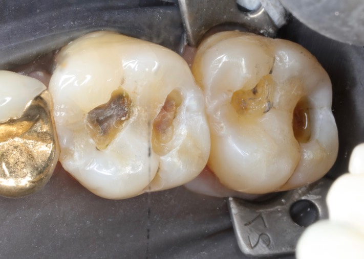 Chris Woo #2 & 3 amalgam removal