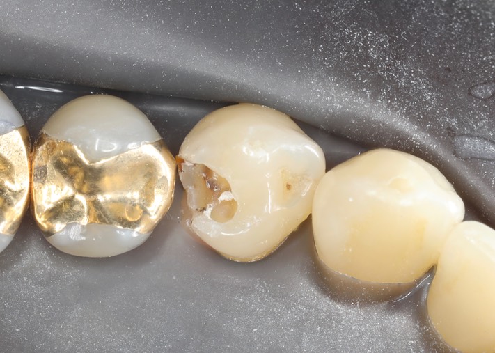 Chris Woo #28 amalgam removal