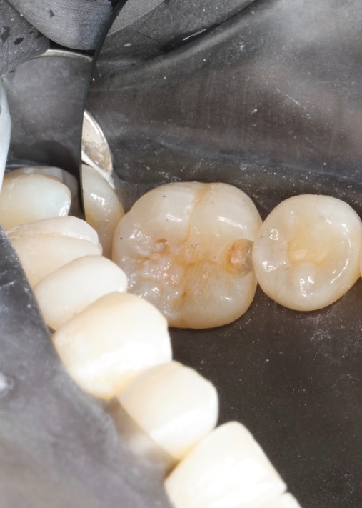 Chris Woo #30 composite removal