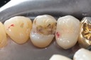 Chris Woo #5 amalgam removal