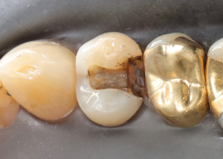 Chris Woo #5 caries removal