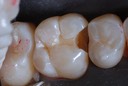 Roland Ylarde #3 comp removal