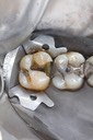Frank Fukuda #15 amalgam removal
