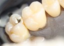 Frank Fukuda #15 pre-op 2