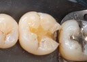 Frank Fukuda #19 amalgam removal