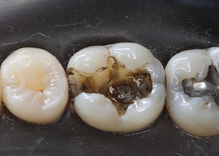 Frank Fukuda #19 amalgam removal