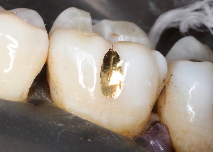 Frank Fukuda #19 buccal foil