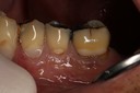 Frank Fukuda #19 buccal pre-op