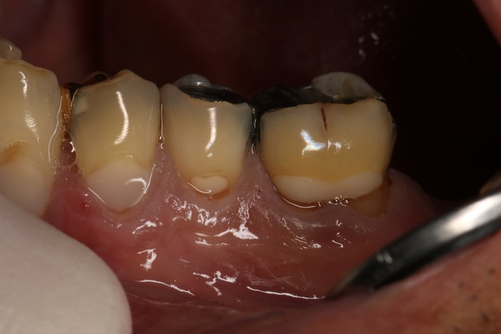 Frank Fukuda #19 buccal pre-op