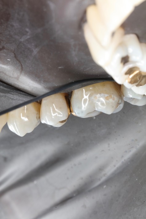Frank Fukuda #3-4 buccal view