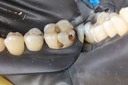 Frank Fukuda #30 amalgam removal buccal