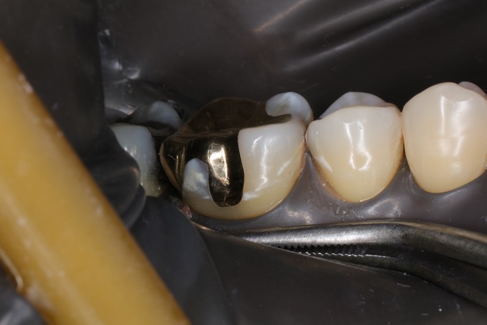 Frank Fukuda #30 buccal view