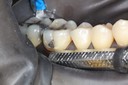 Frank Fukuda #30 pre-op buccal